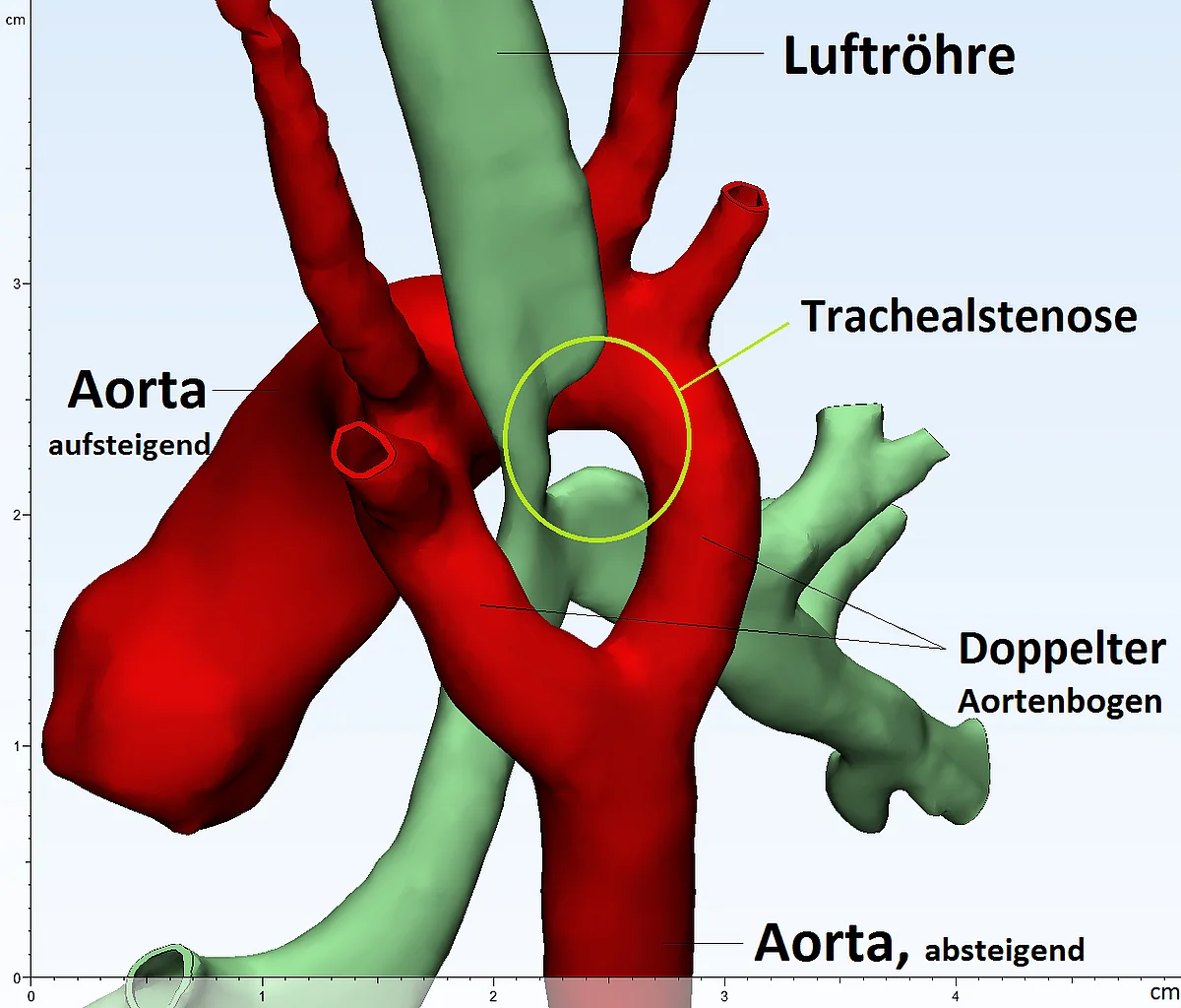 Doppelter Aortenbogen - Kinderkardiologie | Uniklinikum Erlangen