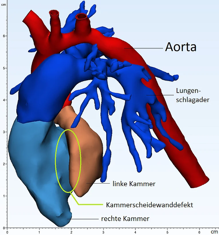 Abb. 3.2.1 – Ansicht von der Seite - Im Zentrum markiert steht der Kammerscheidewanddefekt (VSD) zwischen rechter (RV) und linker Kammer (LV).