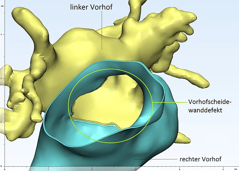 Abb. 3.3.1 Ansicht auf die Vorhöfe, der rechte Vorhof ist aufgeschnitten, sodass man ins Innere sehen kann. . Man erkennt ein großes Loch (ASD) in der Scheidewand zwischen den Vorhöfen (RA und LA).