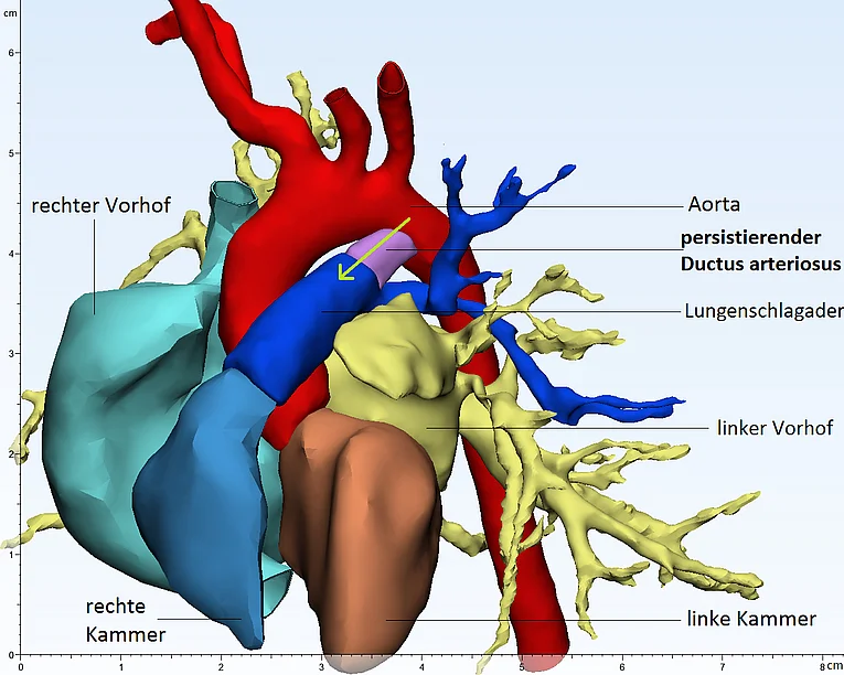 Abb. 3.6.1 Ansicht auf das Herz von vorne. Lila dargestellt sieht man den Ductus arteriosus, als Verbindung zwischen Aorta und Lungenschlagader (PA). Der grüne Pfeil stellt die Richtung des Blutflusses nach Geburt dar. (Links-Rechts-Shunt)