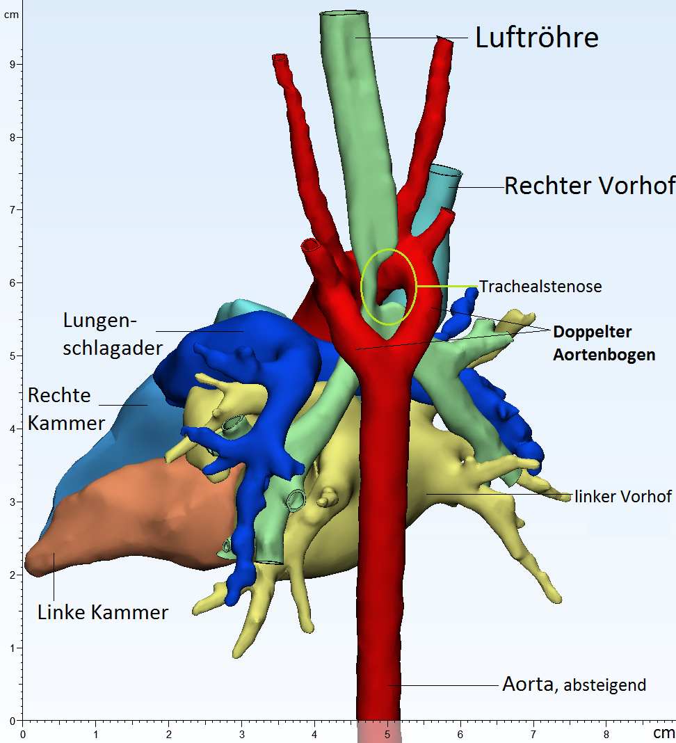 Doppelter Aortenbogen Kinderkardiologie Uniklinikum Erlangen